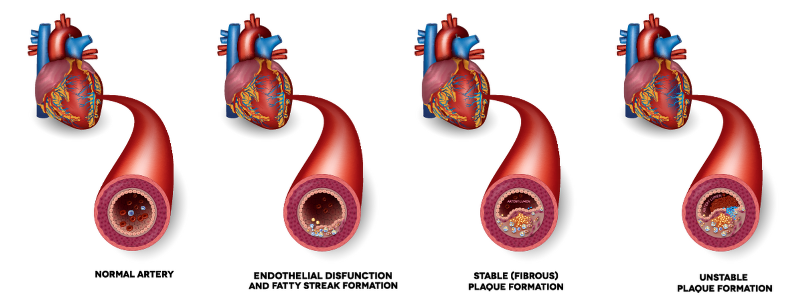 Atherosclerotic Plaque In Arteries Overview • Heart Research Institute 