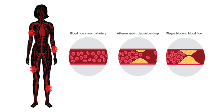 Peripheral Artery Disease (PAD) • Heart Research Institute